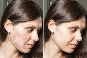 Reduction in Dark Spots <br> and Uneven Tone in 8-12 weeks